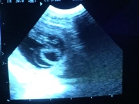 Sonogram 1